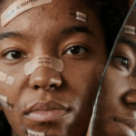 Que problemas de saúde a acne pode criar