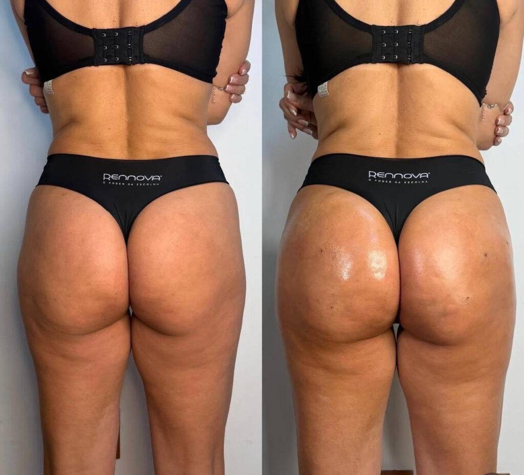 Dra. Camilla Barbosa valida técnica de harmonização glútea ao realizar procedimento em si mesma